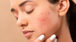 Acne Positivity Day: Η ακμή δεν επηρεάζει μόνο το δέρμα μας